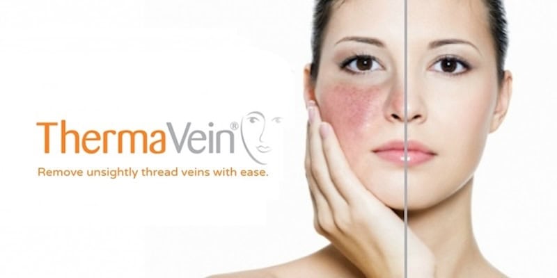 thermavein vein removal