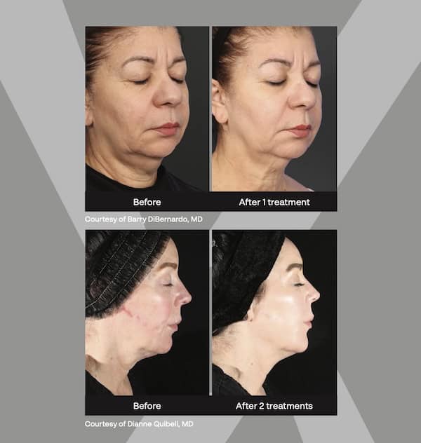 XERF Before and after courtesy of Barry DiBernadro, MD and DIanne Quibell, MD